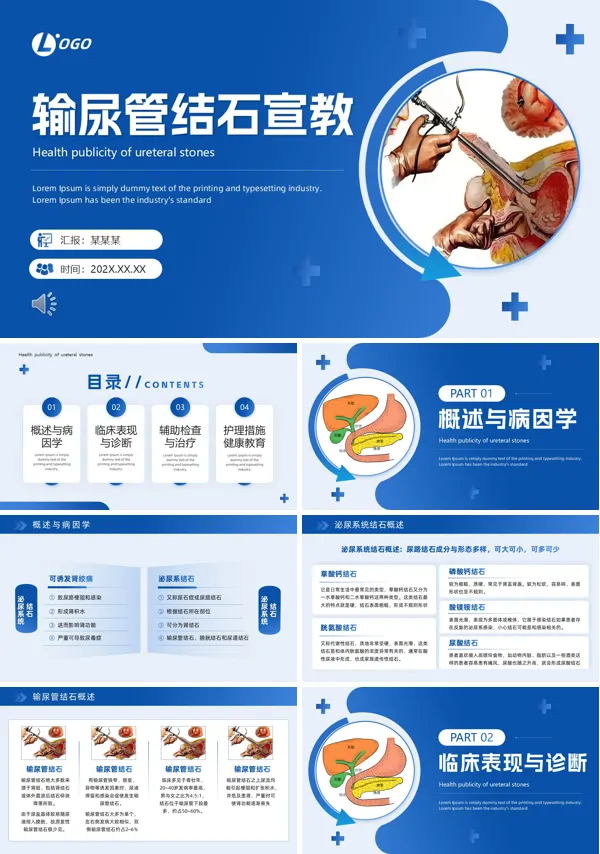 输尿管结石健康宣教PPT模板含讲稿