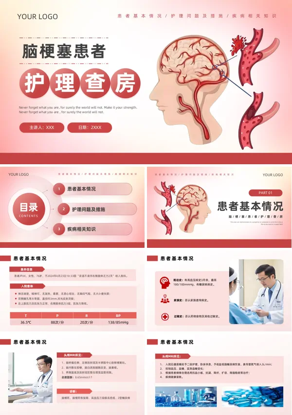 脑梗患者护理查房PPT模板含讲稿
