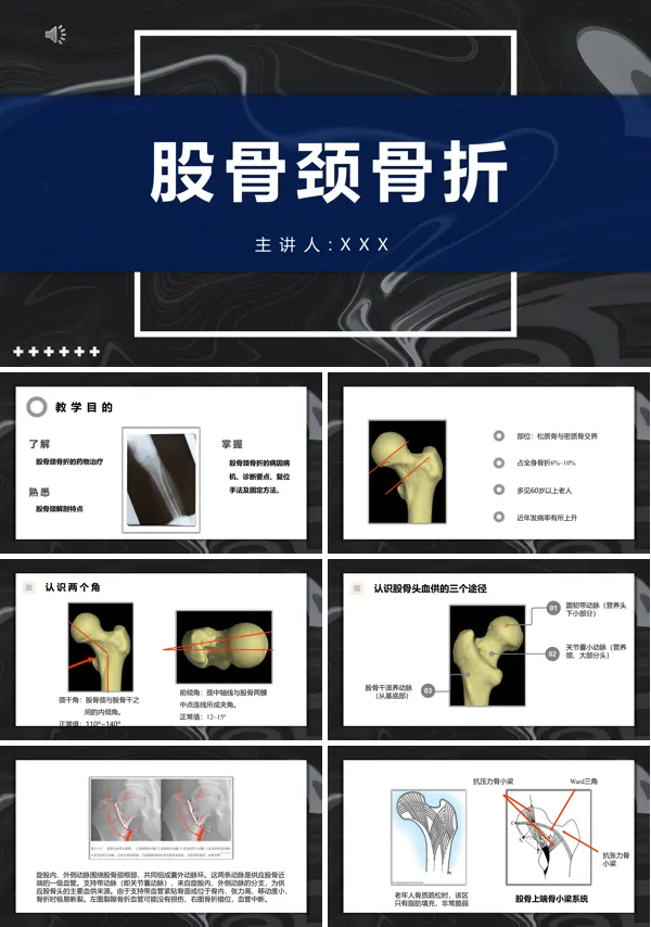 股骨颈骨折ppt课件模板