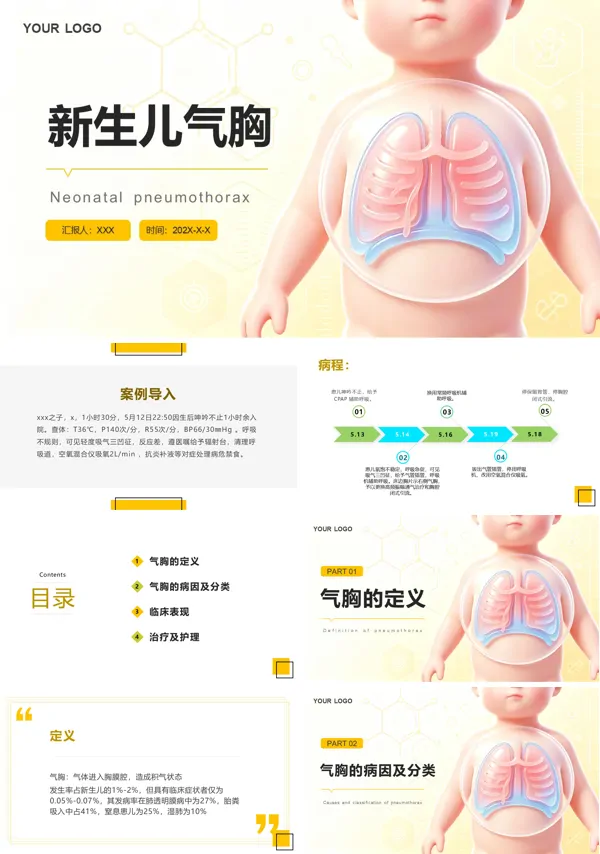 新生儿气胸护理查房教学课件PPT含讲稿