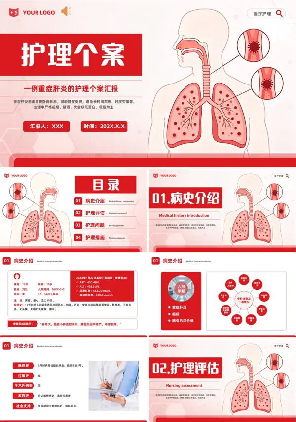 重症肝炎护理个案汇报PPT课件含讲稿