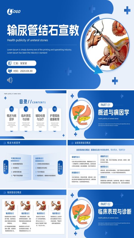 输尿管结石健康宣教PPT模板含讲稿