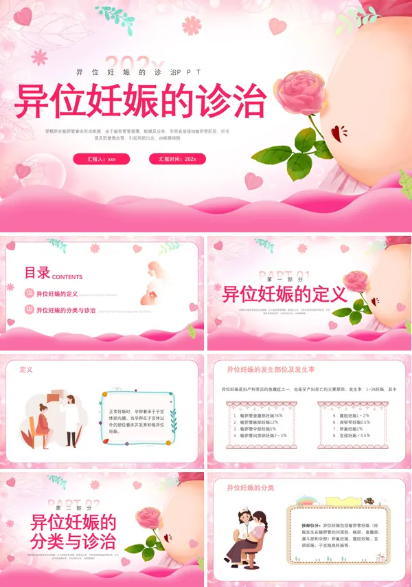 异位妊娠的诊治PPT