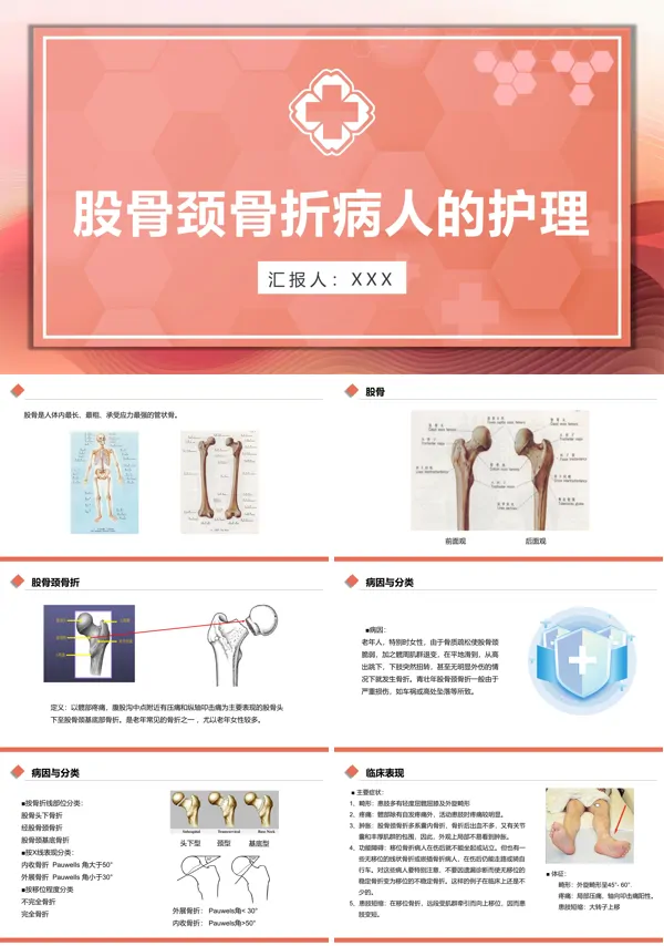 股骨颈骨折护理查房ppt课件