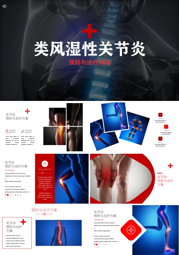 《类风湿性关节炎》ppt课件